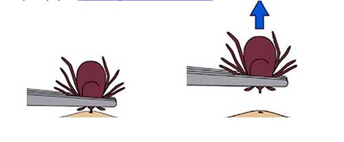 It39s easy to remove a tick just pull it out with tweezers Contrary to commonly repeated removal remedies do not coat the tick with butter oil solvents or touch a hot match to it These practices especially the application of heat can cause the tick to regurgitate material back into the bite increasing the likelihood of infection