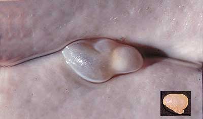 Taenia hydatigena cyst